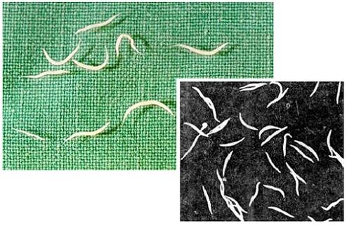 Pinworms από το ανθρώπινο σώμα
